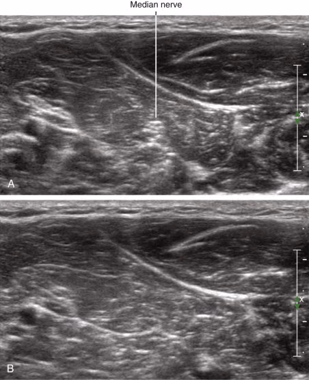 Median nerve appearing bright and dark with change in probe angle (anisotropy)