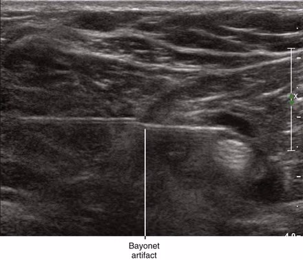 Ultrasound showing the bayonet artifact with an apparently bent needle