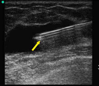 Echogenic needle tip marked by an arrow on ultrasound