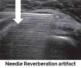 Needle reverberation artifact with equally spaced false echoes
