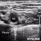 Ultrasound image of the supraclavicular region showing the pleura