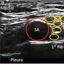 Ultrasound image of the subclavian artery and first rib